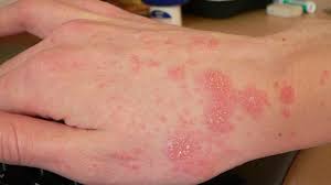 Photo of Unavoidable Facts About Scabies That You Shouldn’t Overlook