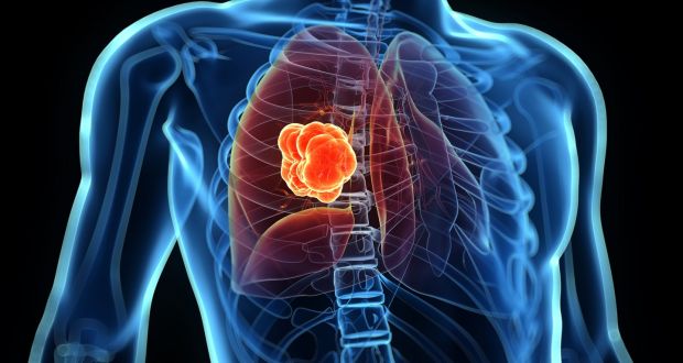 best lung cancer surgeon in Jaipur