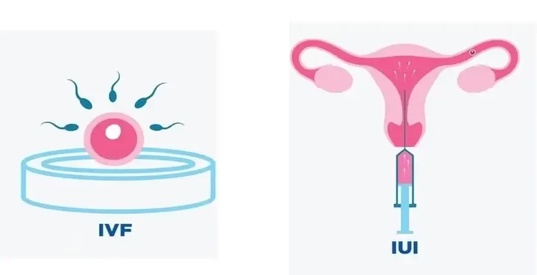 IVF and IUI