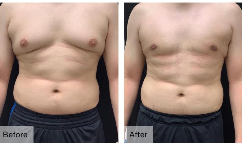 Gynecomastia