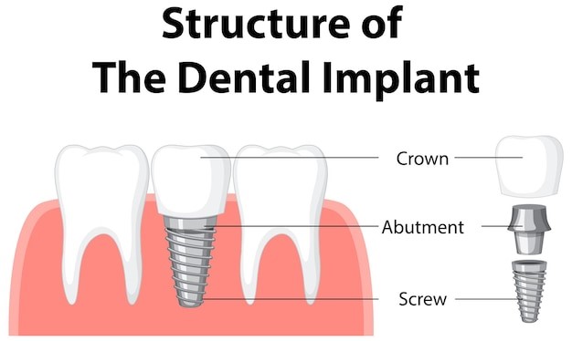 teeth whitening with crowns